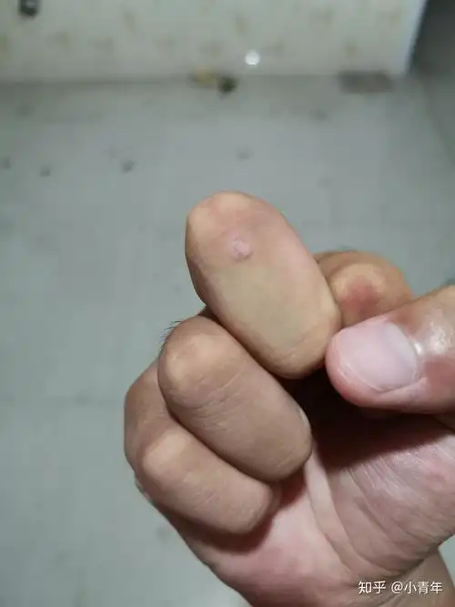 手指上起了几个刺瘊应该用什么药物治疗呢求解答