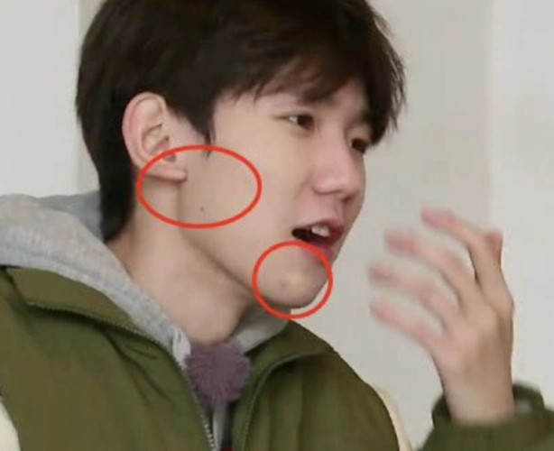 在综艺节目中,素颜出镜的王源脸上也有痘痘的痕迹,要知道,这类节目都