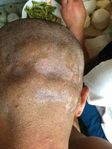 请问这头上的白斑是什么病