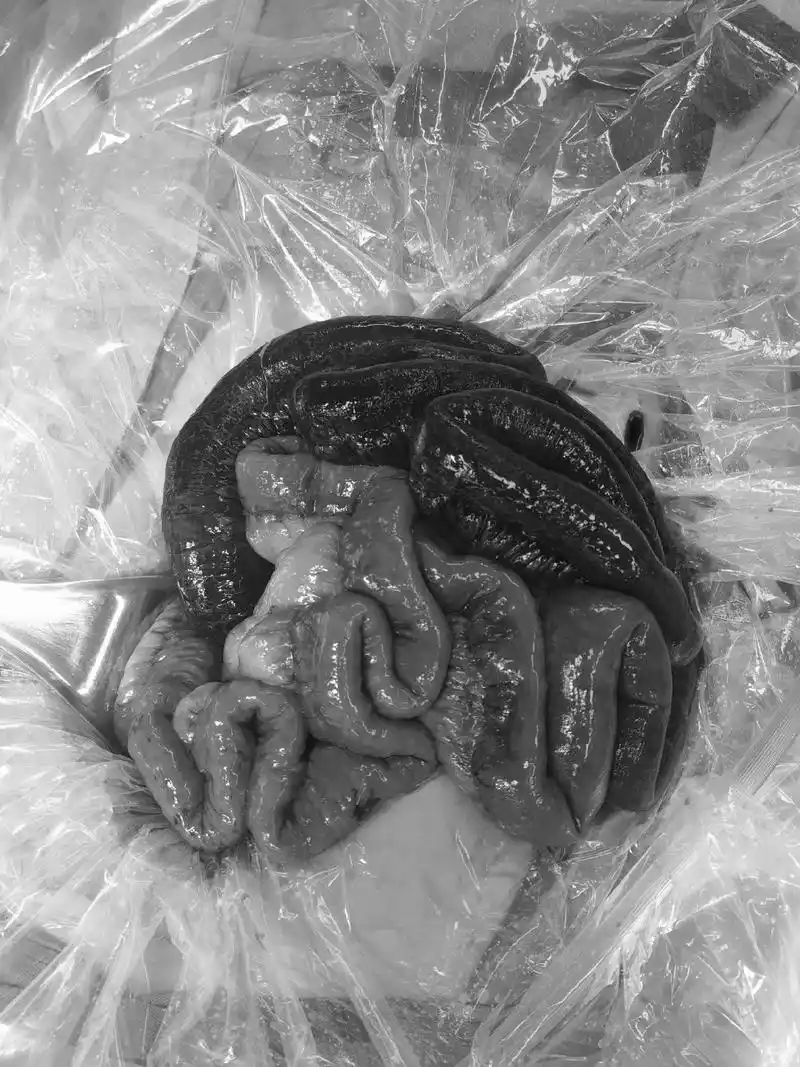 恶心呕吐2周,腹痛1天入院.诊断肠系膜 - 抖音