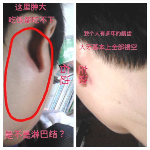 是不是我的淋巴结肿大啊?饭都吃不下,痛死人了