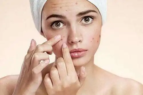 痘痘肌肤的日常护理