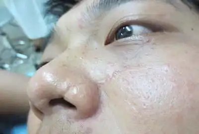 男人隆鼻都需要注意什么硅胶隆鼻有哪些优势