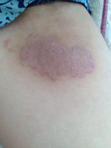 问:孩子大腿内侧起的,这是什么?孩儿说不疼也不痒