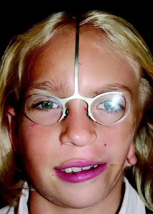 没有耳朵怎么戴眼镜呢?_小耳畸形 - 好大夫在线