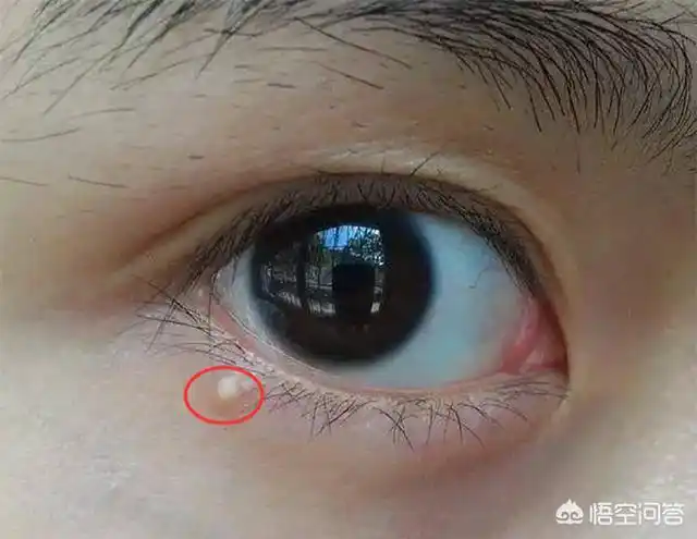 眼睛旁边的脂肪粒怎么去除眼睛周围的脂肪粒能祛除吗