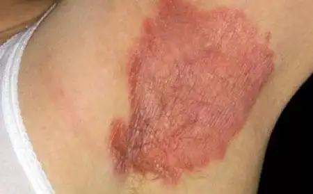 反向牛皮癣的发病原因症状图片诊断治疗方法_潍坊皮肤病医院_潍坊银康