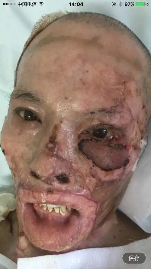 烧伤后左下眼睑外翻畸形植皮修复手术前后照片