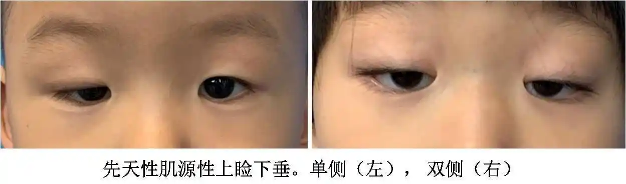 上睑下垂的诊断,治疗和护理_上睑下垂_发病原因_检查_治疗方式_日常