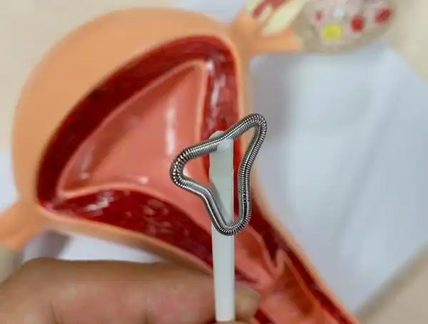 8日那么对于办理了基本医疗保险的女性想要摘取节育环能否用医保报销