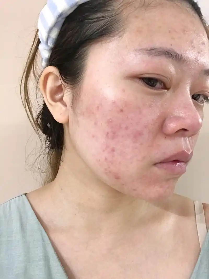 对抗敏感 修复受损角质层(附过敏前后哦对比图)