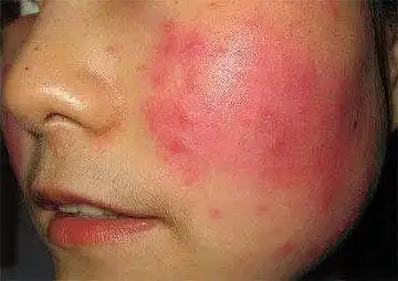 怎么修复红血丝敏感肌肤