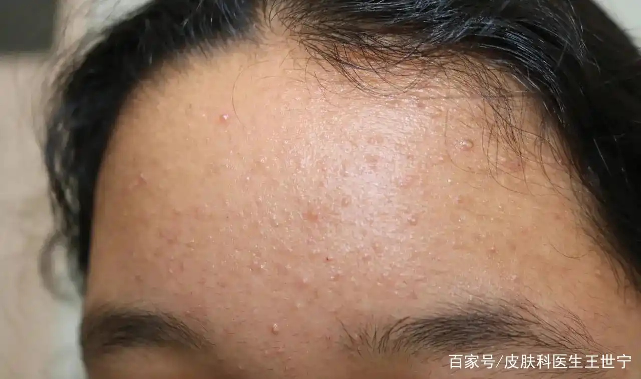 青春期孩子额头长粉刺闭口!