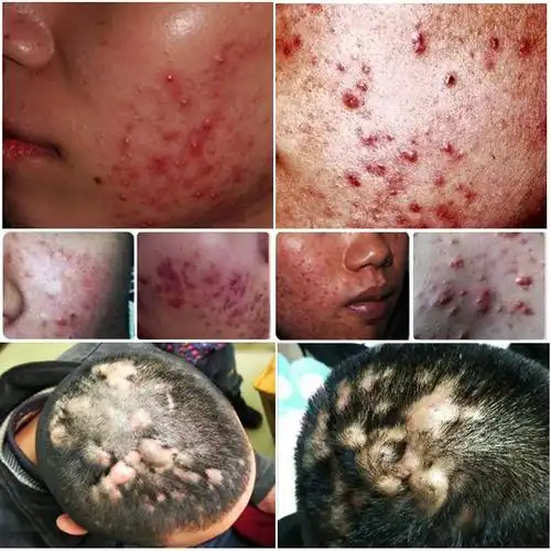 热销鸡皮肤疙瘩毛囊炎_治疗毛囊有炎脓包痤疮私处杀菌头皮背脸部痘痘