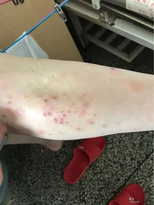 恼人的皮肤病二年多了药也没断过有图慎入