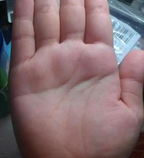 生命线细长,金星丘较扁平,没大病,但体质较弱,小症状多.