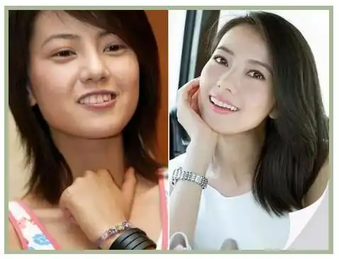 除了我们周边的人喜欢整牙,娱乐圈更是整牙成风,很多明星都喜欢在自己