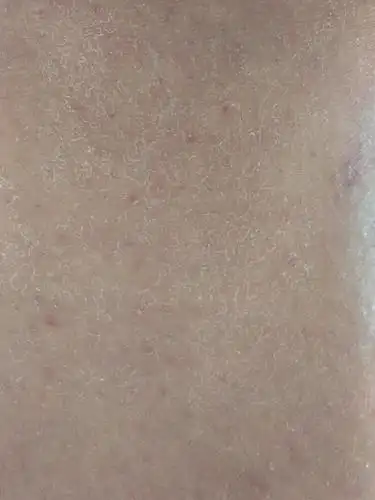 全身都会脱皮,而且紧绷,脸上也干燥,嘴唇也干燥,冬天很严重,夏桃膊