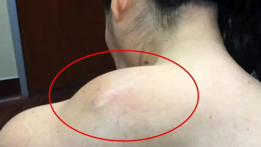 脂肪瘤的致病原因是啥,会癌变吗?