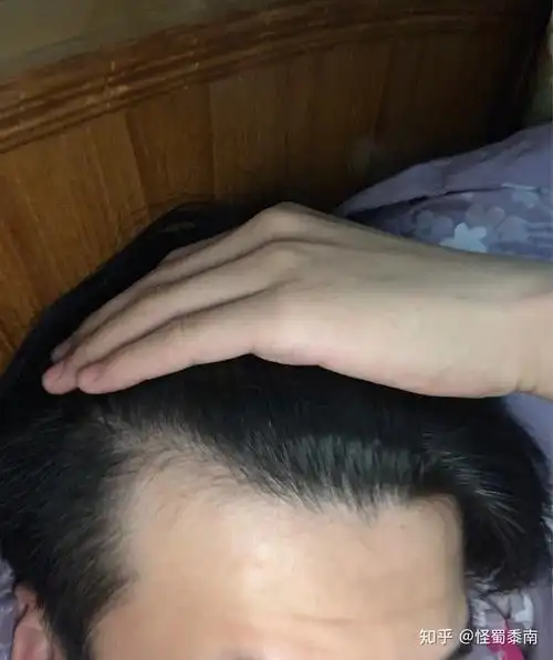 鬓角比以前高了这样是属于脱发吗