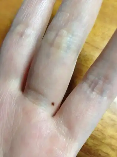 关于三个痣第一个长在手指中间大概是