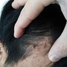 男人肩上有瘊子代表什么意思(女人肩膀有痣)