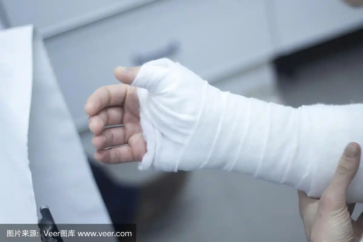 骨折后,医生在患者前臂和手腕上使用石膏石膏和绷带固定.