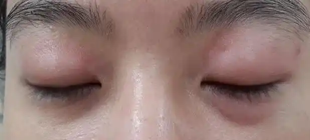 女子午休醒来眼睛肿得像包子可能与这个有关