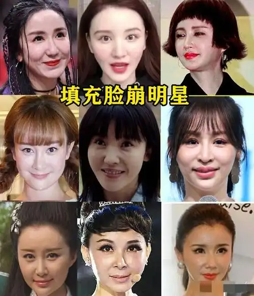 因为面部填充而脸崩的明星巨多,比如王心凌icon,张檬,张萌,杨子姗