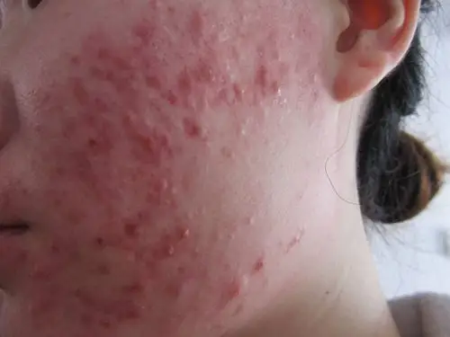 血热的症状痘痘图片8