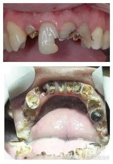 蛀牙烂到牙根怎么办蛀牙只剩牙根了怎么办2022已更新今日图集
