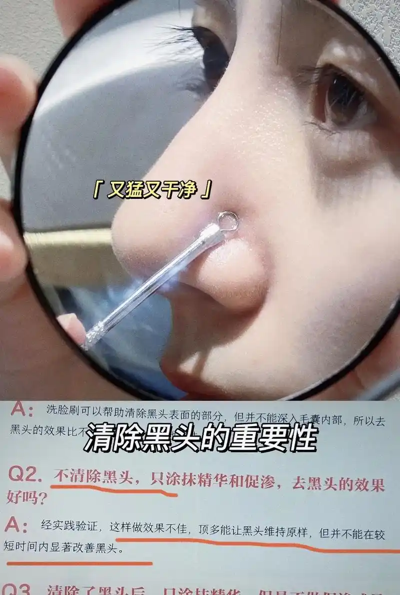 这粉刺针巨巨巨巨好用～去黑头神器!鼻头都干净 - 抖音