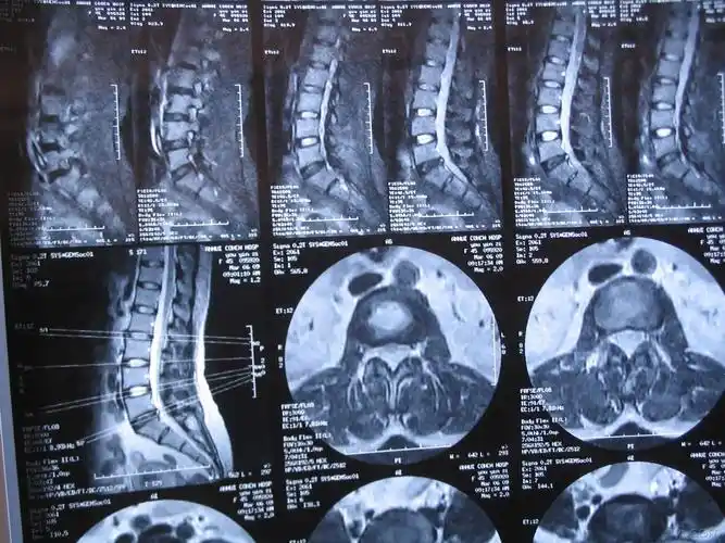 请教我读张腰椎ct片