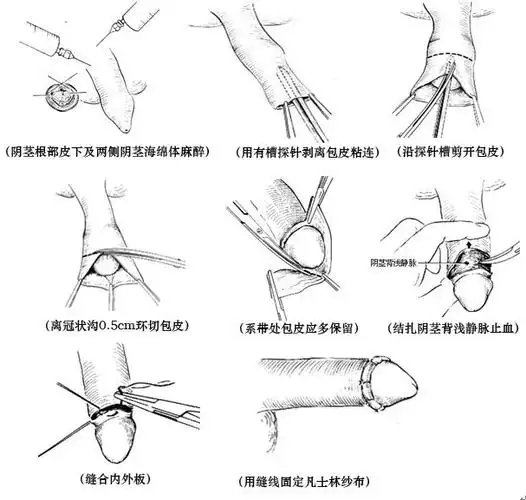 "safe微创包皮环切术" 10分钟无痛微创更安全