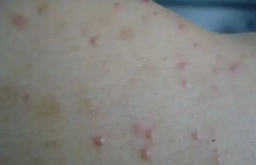 "毛囊炎"有多严重,你是真的知道吗?67治疗预防都要做好!_手机搜狐网