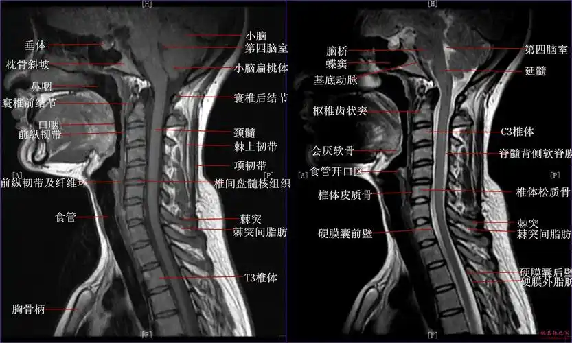 颈椎磁共振(mri)解剖——矢状面