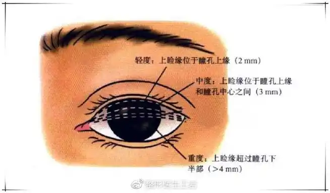 上睑下垂,指正面,平视前方时,上睑睑缘高度低于正常位置的状态.