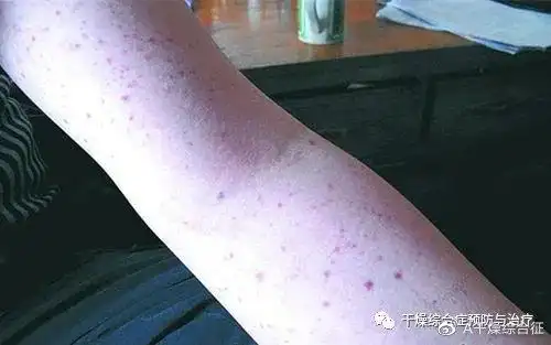 祛燥生津汤解读干燥综合征的10问10答