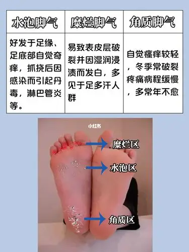 脚气大作战|全方位教你成功去脚气_软膏_夏天去哪玩_脚部_清洁_鞋袜
