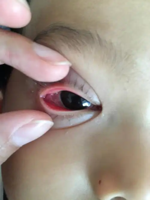 三岁儿子右眼睑红,发现当天晚上姥姥误把红霉素软膏涂点在眼睛里,第