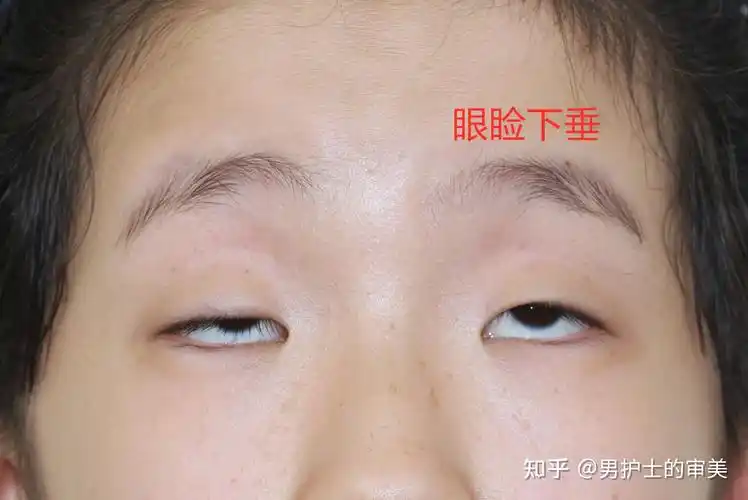 病因: 上睑下垂的主要原因和遗传有关,提肌发育不好导致眼睑无力睁眼