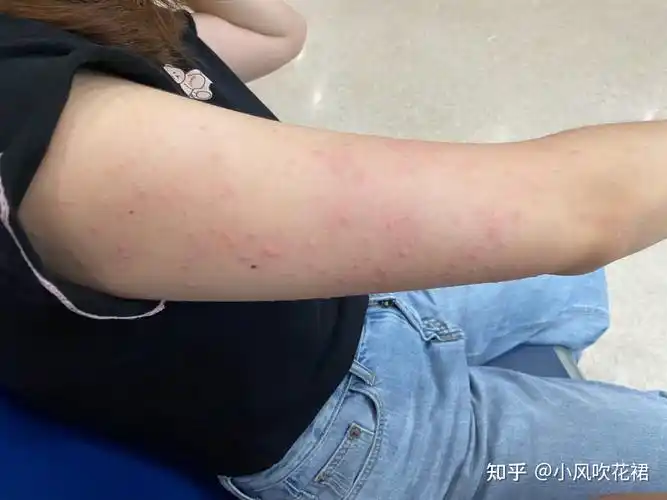 晚上虾过敏是什么感受