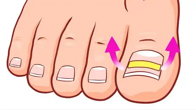 脚趾甲老往肉里钻,一碰还疼,是甲沟炎吗?怎么预防?