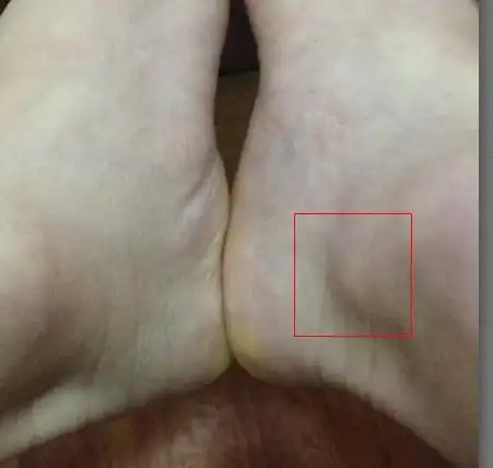 右脚脚掌的距骨位置,类似有一块软骨突出,用力按会痛,不知道怎么造成