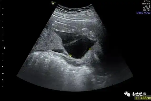 胎盘的下缘为血窦时