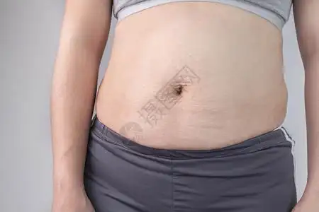 正面裸腿饮食女士为了妇腹部皮肤近前视在分娩后有伸展痕迹和松皮对肤