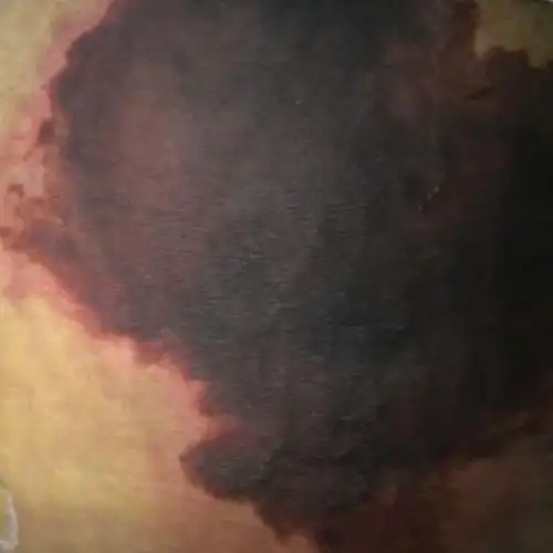 我想问下抽脂以后坏死的皮肤还可以恢复吗,之前是一片红色的,之后就