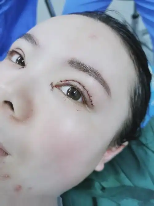 最终选择在上海德媛做的全切双眼皮开眼角,分享一下我术后即刻的照片
