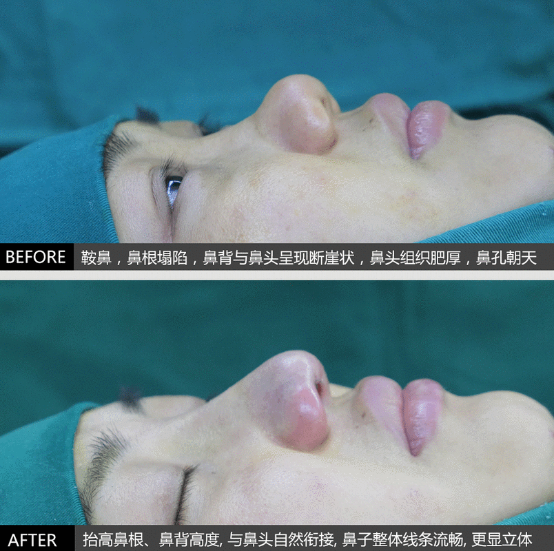 天生塌鼻梁,一定要隆起来才好看吗?