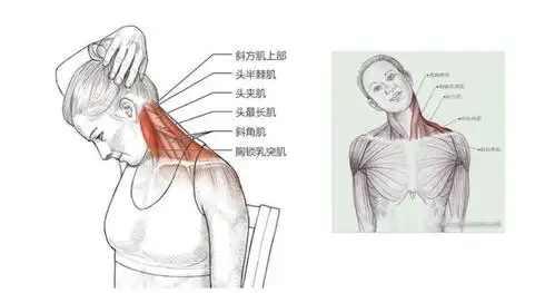 手臂麻!颈椎病最重要的一块肌肉-斜角肌